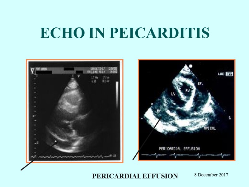 ECHO IN PEICARDITIS PERICARDIAL EFFUSION         